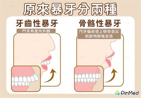 門牙暴牙面相|【暴牙 面相】暴牙的面相特徵！牙齒看性格，超神準！